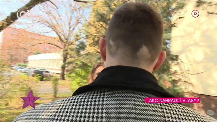 Moderátor Bruno Ciberej má ochorenie menom alopécia